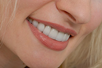Tooth Restoration Services